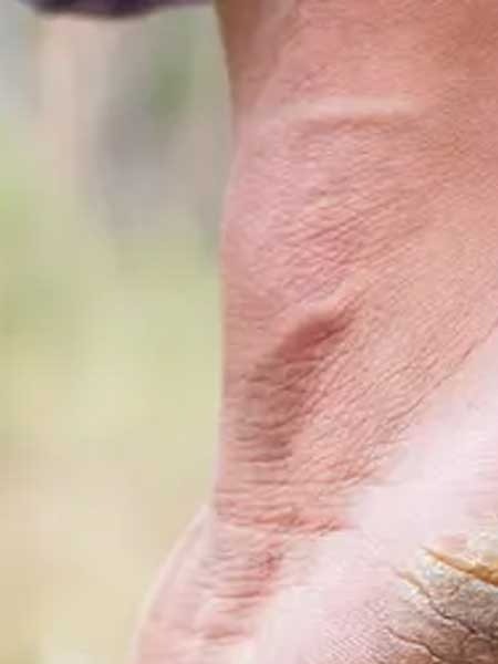 टाचांना वर्षभर भेगा असण्याची ३ मुख्य कारणं... - Marathi News | टाचांना वर्षभर भेगा असण्याची ३ मुख्य कारणं... | Latest Photos at Lokmat.com