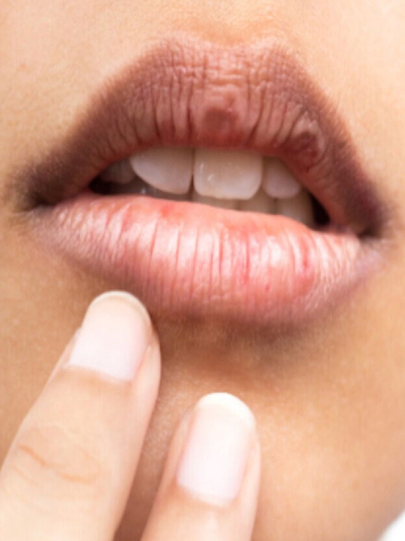 हिवाळ्यात ओठांजवळील त्वचा काळवंडते? - Marathi News | हिवाळ्यात ओठांजवळील त्वचा काळवंडते? | Latest Photos at Lokmat.com