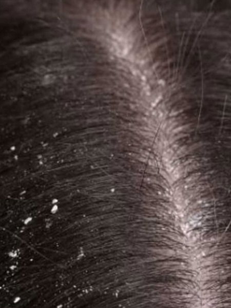 हिवाळ्यात डोक्यातला कोंडा वाढू नये म्हणून ५ टिप्स - Marathi News | हिवाळ्यात डोक्यातला कोंडा वाढू नये म्हणून ५ टिप्स | Latest Photos at Lokmat.com हिवाळ्यात डोक्यातला कोंडा वाढू नये म्हणून ५ टिप्स - Marathi News | हिवाळ्यात डोक्यातला कोंडा वाढू नये म्हणून ५ टिप्स | Latest Photos at Lokmat.com