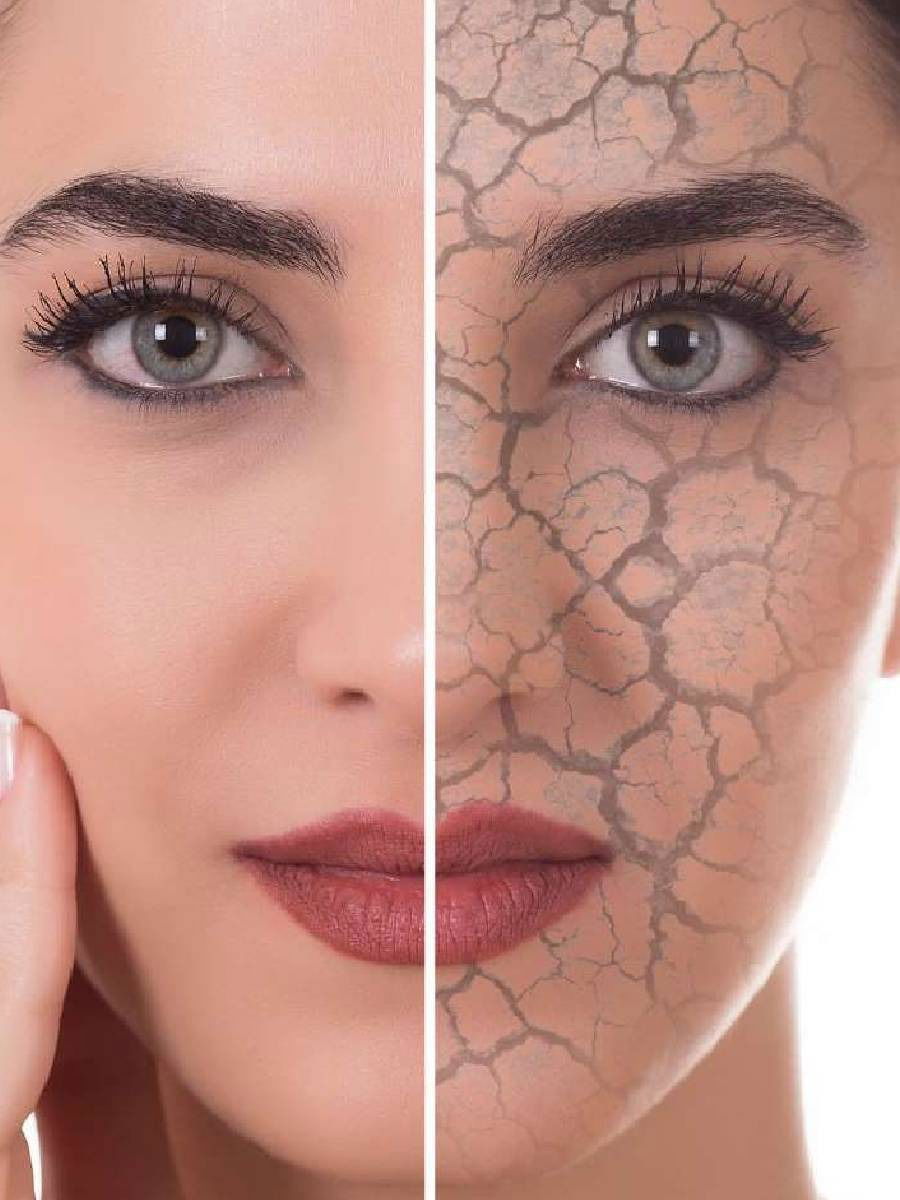 चेहऱ्याची कोरडी त्वचा कशी बरी करावी? - Marathi News | चेहऱ्याची कोरडी त्वचा कशी बरी करावी? | Latest Photos at Lokmat.com