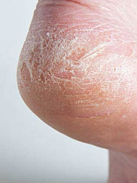 ५ सोपे उपाय, भेगाळलेल्या टाचा होतील मऊ- मुलायम - Marathi News | ५ सोपे उपाय, भेगाळलेल्या टाचा होतील मऊ- मुलायम | Latest Photos at Lokmat.com ५ सोपे उपाय, भेगाळलेल्या टाचा होतील मऊ- मुलायम - Marathi News | ५ सोपे उपाय, भेगाळलेल्या टाचा होतील मऊ- मुलायम | Latest Photos at Lokmat.com