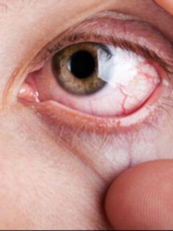 डोळ्यांचा गंभीर आजार;काय आहे केराटोकोनस? - Marathi News | डोळ्यांचा गंभीर आजार;काय आहे केराटोकोनस? | Latest Photos at Lokmat.com