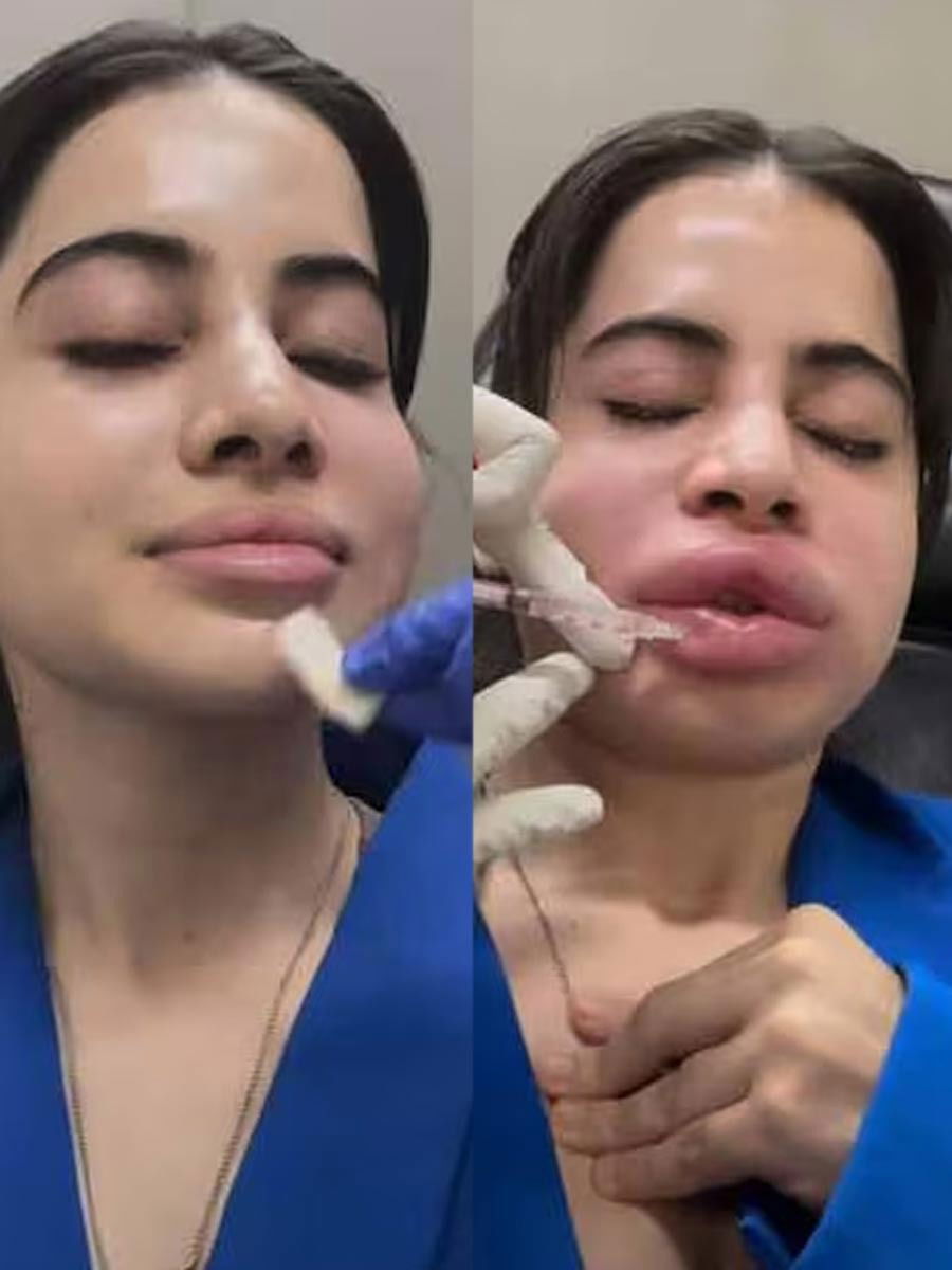 सौंदर्यासाठी नाक व ओठांवर उपचार केलेल्या ६ अभिनेत्री - Marathi News | सौंदर्यासाठी नाक व ओठांवर उपचार केलेल्या ६ अभिनेत्री | Latest Photos at Lokmat.com