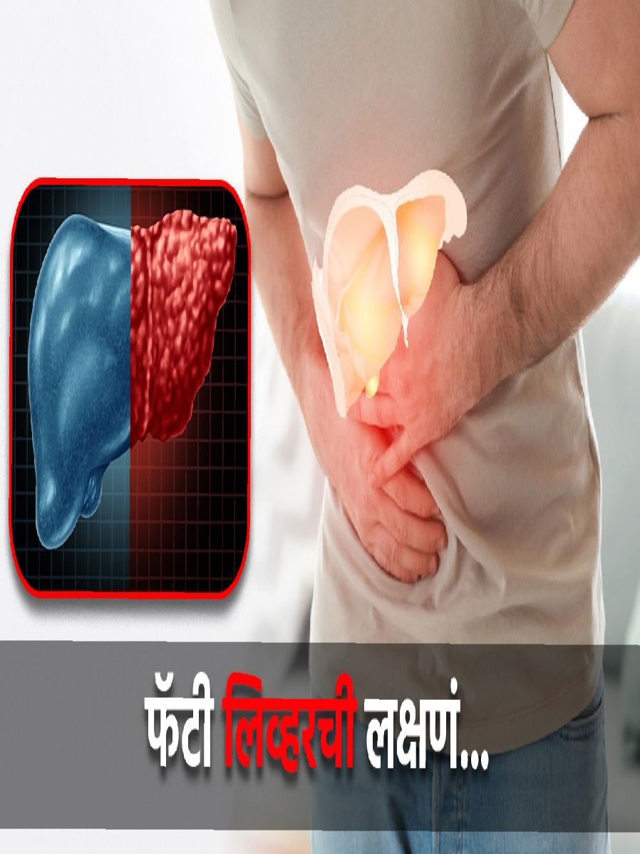 लिव्हर बिघडतंय? ही आहेत फॅटी लिव्हरची ५ महत्त्वाची लक्षण - Marathi News | लिव्हर बिघडतंय? ही आहेत फॅटी लिव्हरची ५ महत्त्वाची लक्षण | Latest Photos at Lokmat.com