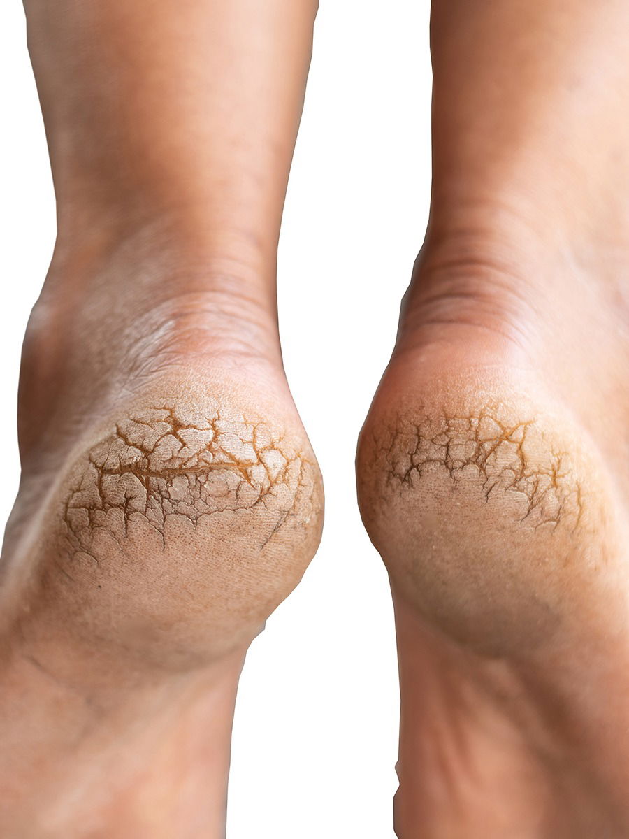 आता हिवाळ्यात टाचांना पडणार नाहीत भेगा! - Marathi News | आता हिवाळ्यात टाचांना पडणार नाहीत भेगा! | Latest Photos at Lokmat.com