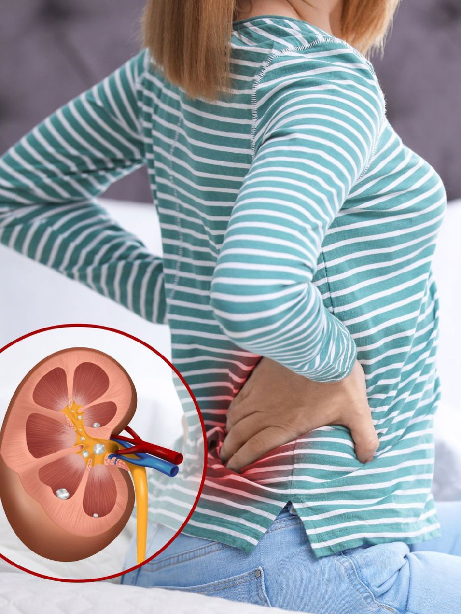 किडनी स्टोन नेमका होतो तरी कशामुळे? जाणून घ्या त्यामागची कारणं - Marathi News | किडनी स्टोन नेमका होतो तरी कशामुळे? जाणून घ्या त्यामागची कारणं | Latest Photos at Lokmat.com