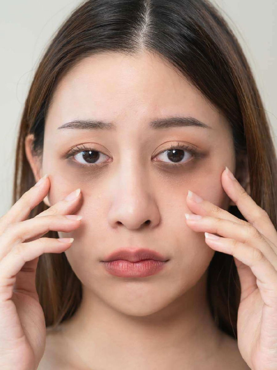 डार्क सर्कल कमी करण्यासाठी फॉलो करा या ३ टिप्स - Marathi News | डार्क सर्कल कमी करण्यासाठी फॉलो करा या ३ टिप्स | Latest Photos at Lokmat.com