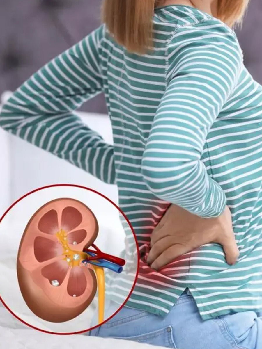 किडनी स्टोन आहे? मग 'या' पदार्थांना चुकूनही लावू नका हात - Marathi News | किडनी स्टोन आहे? मग 'या' पदार्थांना चुकूनही लावू नका हात | Latest Photos at Lokmat.com