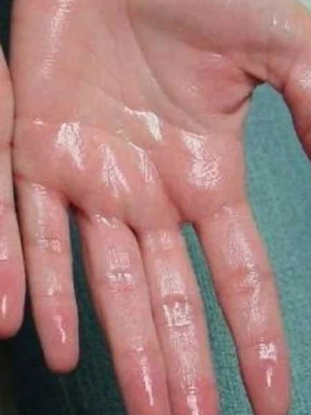 हाताच्या तळव्यांना फार घाम येतो? पाहा उपाय - Marathi News | हाताच्या तळव्यांना फार घाम येतो? पाहा उपाय | Latest Photos at Lokmat.com