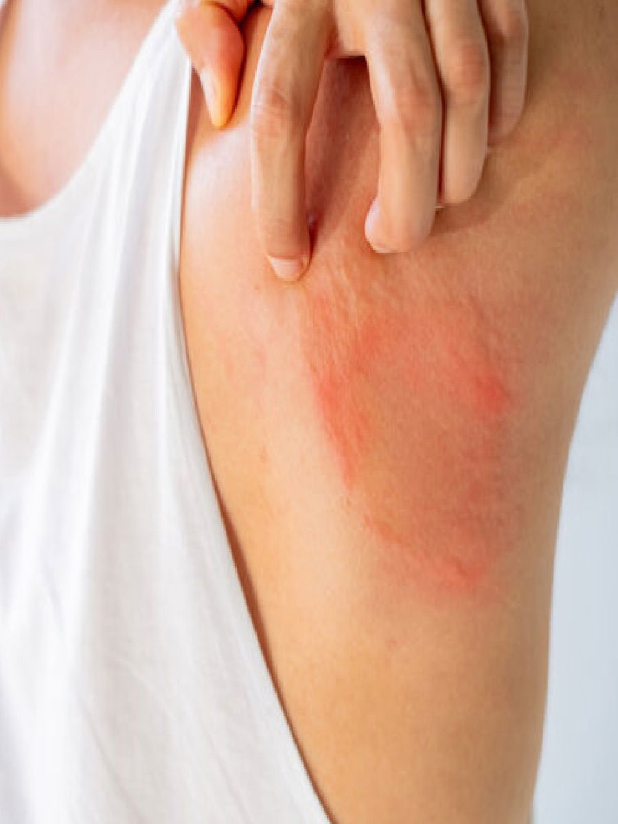 फंगल इंफेक्शनने त्रस्त असाल तर ट्राय करा घरगुती उपाय - Marathi News | फंगल इंफेक्शनने त्रस्त असाल तर ट्राय करा घरगुती उपाय | Latest Photos at Lokmat.com