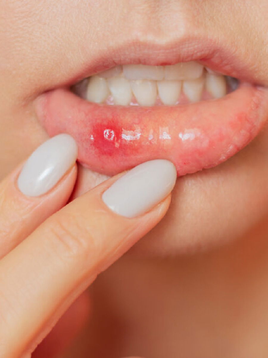 आता उष्णतेमुळे जिभेला येणार नाही फोड; 'हे' ५ उपाय ठरतील फायदेशीर - Marathi News | आता उष्णतेमुळे जिभेला येणार नाही फोड; 'हे' ५ उपाय ठरतील फायदेशीर | Latest Photos at Lokmat.com