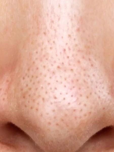 नाकावरील हट्टी ब्लॅकहेड्स घालवण्याचे ७ घरगुती उपाय... - Marathi News | नाकावरील हट्टी ब्लॅकहेड्स घालवण्याचे ७ घरगुती उपाय... | Latest Photos at Lokmat.com