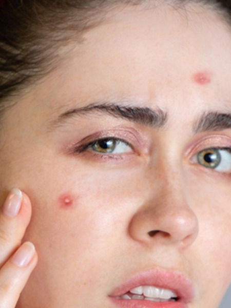 पिंपल्स आले? 'हे' जादुई पाणी प्या, पिंपल्स गायब - Marathi News | पिंपल्स आले? 'हे' जादुई पाणी प्या, पिंपल्स गायब | Latest Photos at Lokmat.com