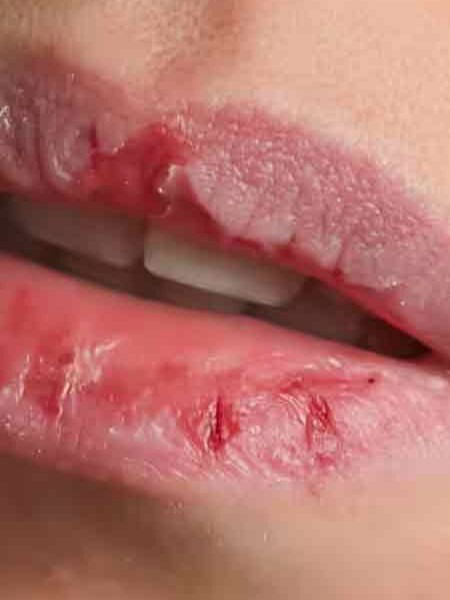 काही जणांचे ओठ नेहमीच कोरडे पडतात, कारण.... - Marathi News | काही जणांचे ओठ नेहमीच कोरडे पडतात, कारण.... | Latest Photos at Lokmat.com काही जणांचे ओठ नेहमीच कोरडे पडतात, कारण.... - Marathi News | काही जणांचे ओठ नेहमीच कोरडे पडतात, कारण.... | Latest Photos at Lokmat.com