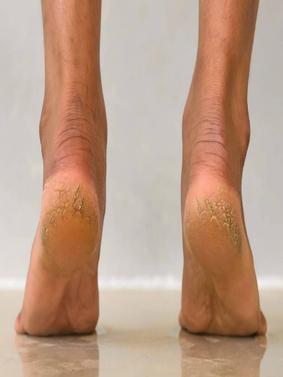 हिवाळ्यात तुमचे हात-पाय फुटणार नाहीत, दररोज करा या ५ गोष्टी - Marathi News | हिवाळ्यात तुमचे हात-पाय फुटणार नाहीत, दररोज करा या ५ गोष्टी | Latest Photos at Lokmat.com