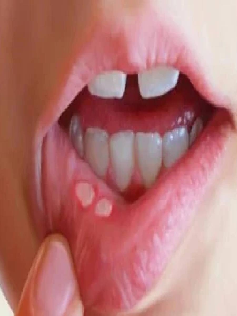 तुम्हालाही सारखं तोंड येतं? जाणून घ्या कारणे - Marathi News | तुम्हालाही सारखं तोंड येतं? जाणून घ्या कारणे | Latest Photos at Lokmat.com