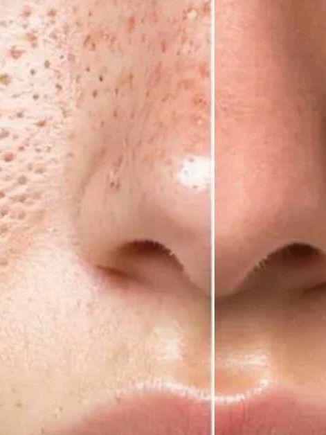 नाकावरील ओपन पोअर्सवर उपाय - Marathi News | नाकावरील ओपन पोअर्सवर उपाय | Latest Photos at Lokmat.com