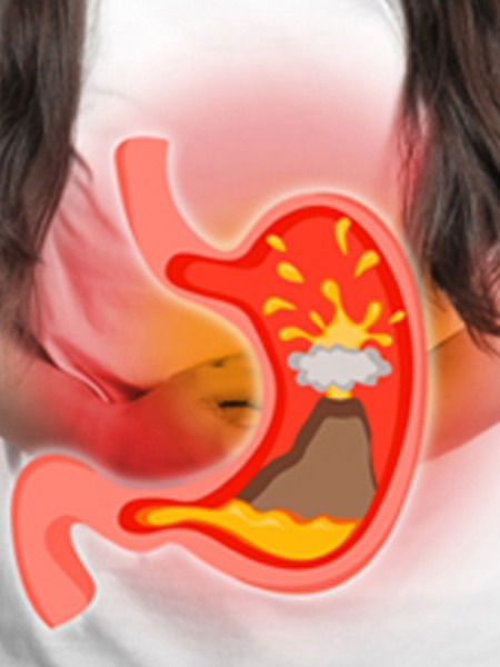 अॅसिडीटी होणार नाही, टाळा हे '६' पदार्थ - Marathi News | अॅसिडीटी होणार नाही, टाळा हे '६' पदार्थ | Latest Photos at Lokmat.com अॅसिडीटी होणार नाही, टाळा हे '६' पदार्थ - Marathi News | अॅसिडीटी होणार नाही, टाळा हे '६' पदार्थ | Latest Photos at Lokmat.com