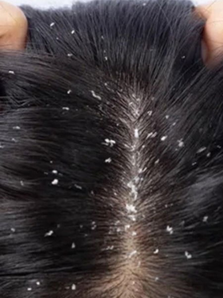 फक्त एकदा ट्राय करून पाहा- डोक्यातला कोंडा होईल गायब - Marathi News | फक्त एकदा ट्राय करून पाहा- डोक्यातला कोंडा होईल गायब | Latest Photos at Lokmat.com फक्त एकदा ट्राय करून पाहा- डोक्यातला कोंडा होईल गायब - Marathi News | फक्त एकदा ट्राय करून पाहा- डोक्यातला कोंडा होईल गायब | Latest Photos at Lokmat.com