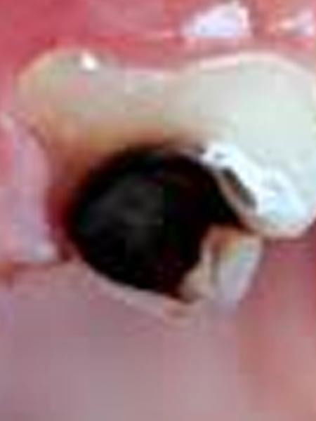 किडलेल्या दातांवर घरगुती उपाय - Marathi News | किडलेल्या दातांवर घरगुती उपाय | Latest Photos at Lokmat.com