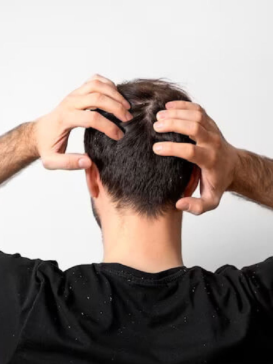 केसातील कोंड्याने त्रस्त झालात? करुन बघा हे घरगुती उपाय - Marathi News | केसातील कोंड्याने त्रस्त झालात? करुन बघा हे घरगुती उपाय | Latest Photos at Lokmat.com