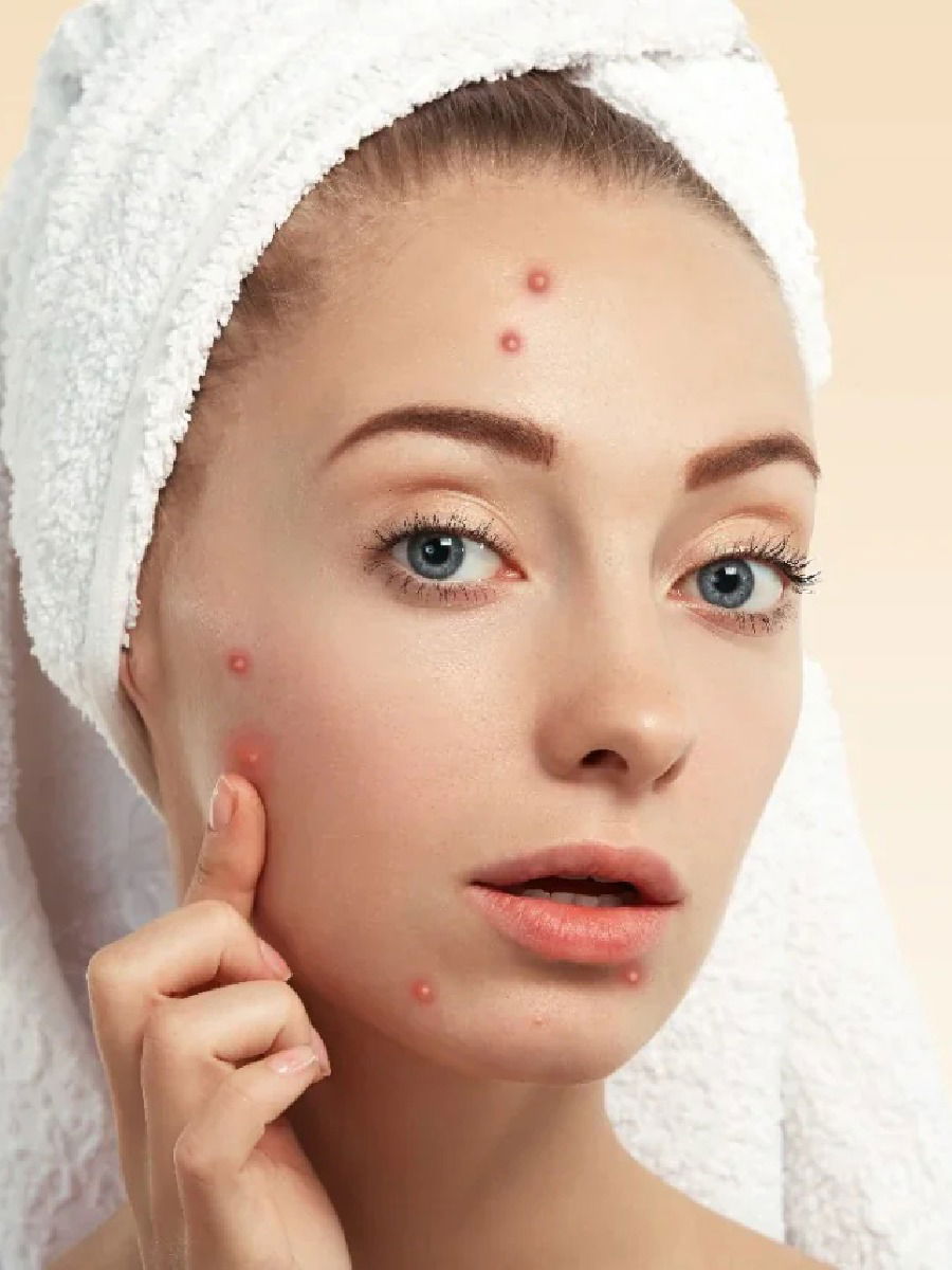 चेहऱ्यावर पिंपल्स येण्यामागे 'हे' 5 व्हिटामिन्स आहेत कारणीभूत - Marathi News | चेहऱ्यावर पिंपल्स येण्यामागे 'हे' 5 व्हिटामिन्स आहेत कारणीभूत | Latest Photos at Lokmat.com